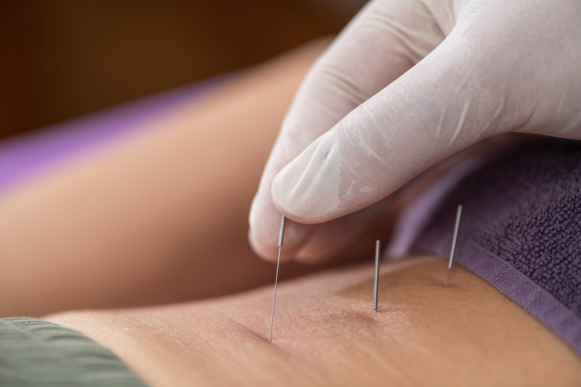 physical-therapist-performing-dry-needling-on-a-pa-2024-12-03-22-24-22-utc